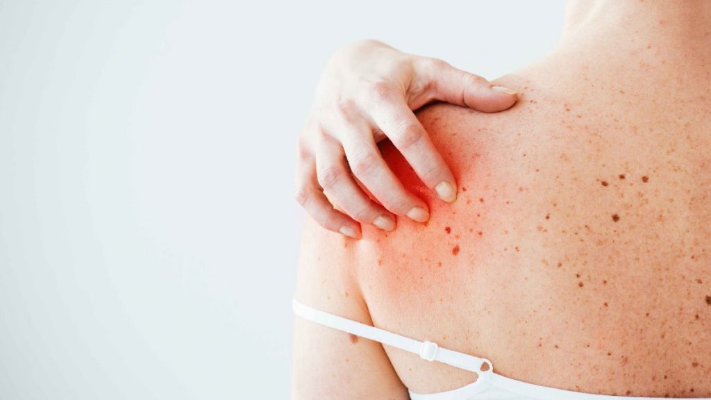 Cilt kanserinin en yaygın 7 belirtisi