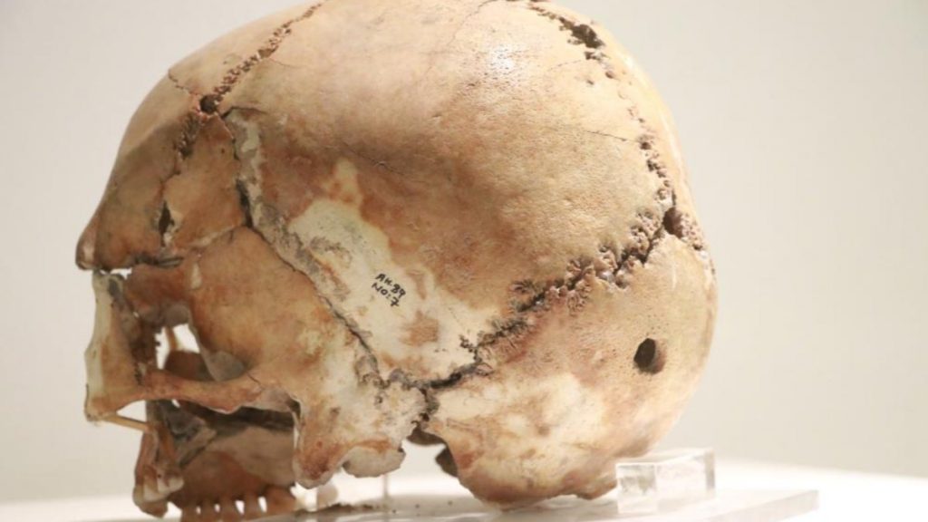 Dünyanın ilk beyin ameliyatı Aksaray’da, 10 bin 500 yıl önce yapıldı