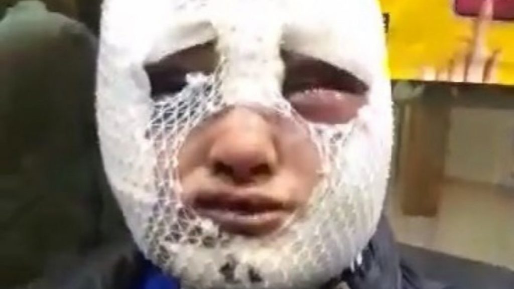 Hatay’da eski kız arkadaşının yüzüne kızgın yağ döken sanık tahliye edildi