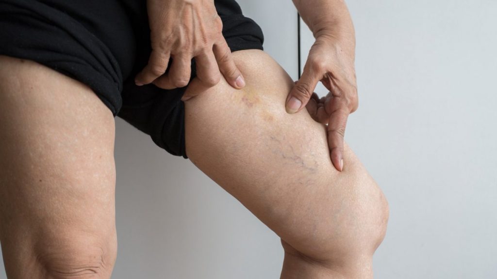 Varisli damarlara karşı 7 etkili doğal tedavi