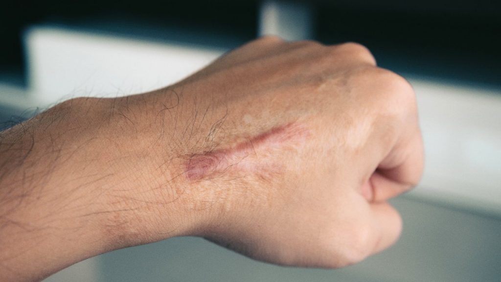 Yara izleri için 7 doğal çözüm