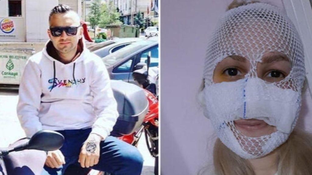 Ankara’da Sultan’ın yüzüne kimyasal madde atan şahıs yakalandı